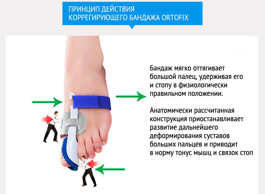 Действие фиксатора Ortofix Gess 