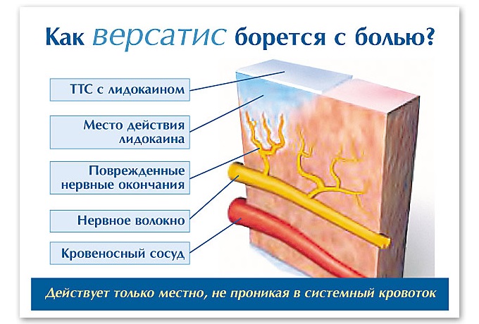 Действие пластыря Версатис на боль
