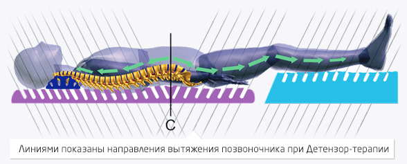 Суть вытяжения детензор-терапией