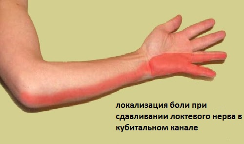 Диагностика боли при защемлении локтевого нерва