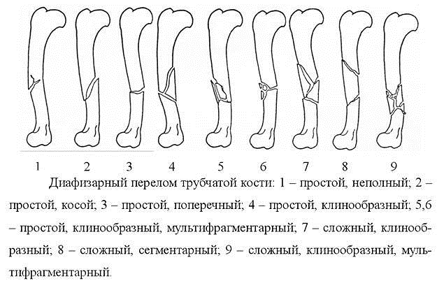 Диафизарные переломы