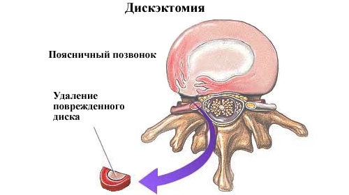 Дискэктомия