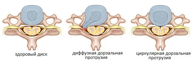 Диффузная и циркулярная дорзальная протрузия