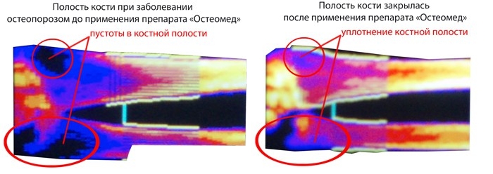 Эффективность Остеомеда