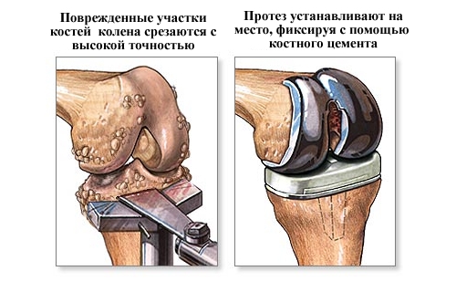 Эндопротезирование колена