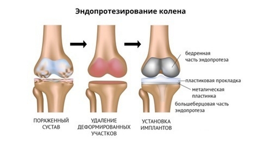 Эндопротезирование при разрушении коленного сустава