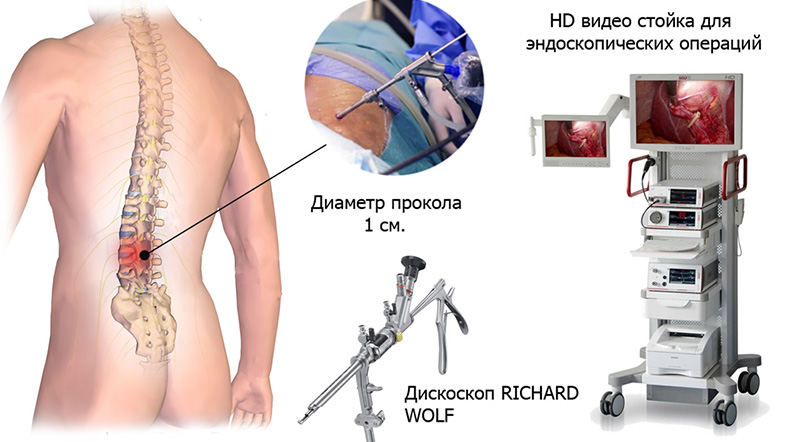 Эндоскопическая операция по удалению грыжи позвоночника