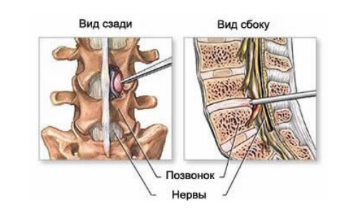 Эндоскопия поясничного отдела при грыже диска