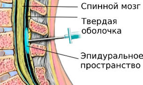 Эпидуральная блокада