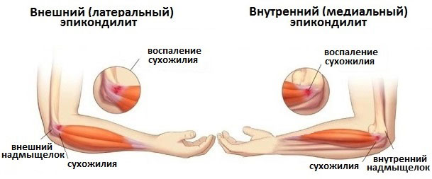 Виды эпикондилита локтевого сустава