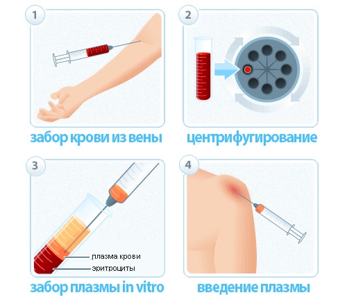 Этапы плазмофитинга