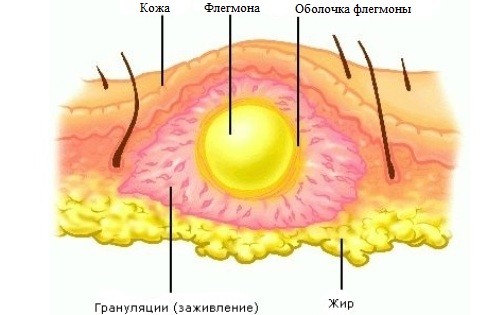 Флегмона