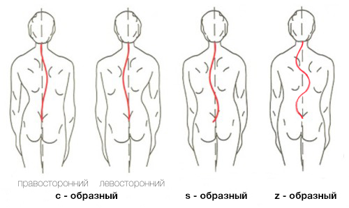 Формы сколиоза