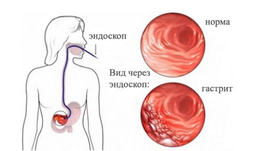 Гастрит