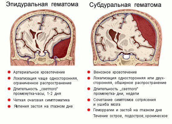 Внутричерепные гематомы