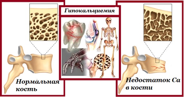 Гипокальцемия