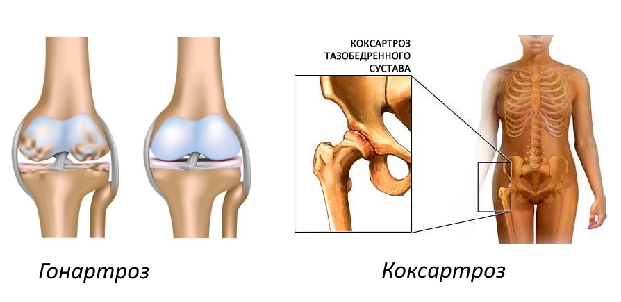 Гонартроз и коксартроз