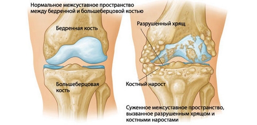 Гонартроз