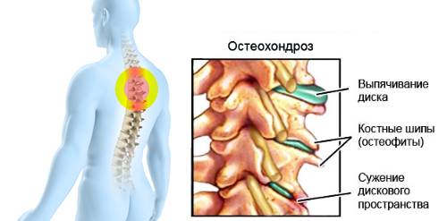 Грудной остеохондроз позвоночника