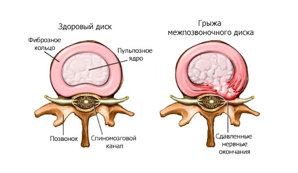 Грыжа диска позвоночника