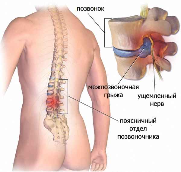Грыжа поясничного отдела позвоночника
