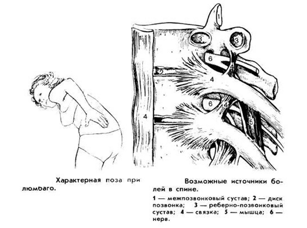 Характерная поза и возможные источники люмбаго