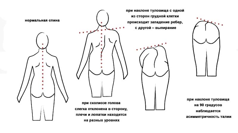 Характерные признаки сколиоза