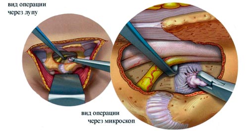 Хирургическое лечение грыжи диска
