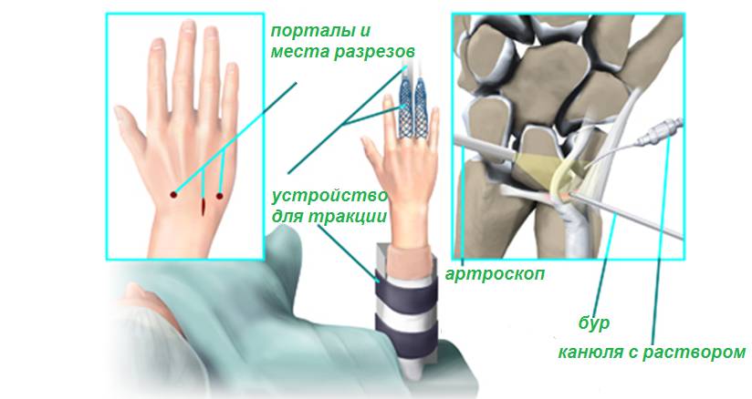 Хирургическое лечение синовита кисти