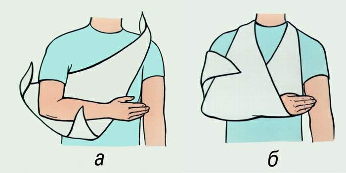 Иммобилизация плеча
