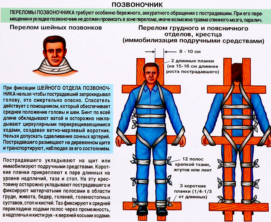 Иммобилизация при переломе позвоночника