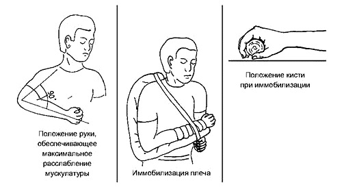 Иммобилизация при переломе предплечья