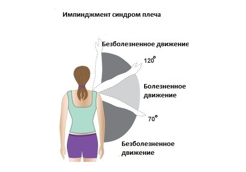 Боль при импинджмент–синдроме плечевого сустава