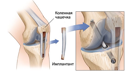 Имплантация для ПКС