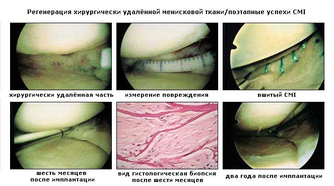 Имплантация мениска