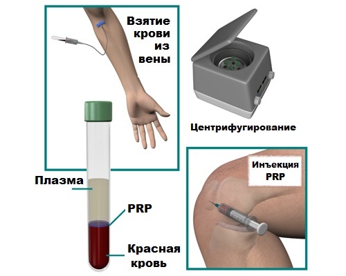 Инъекции PRP