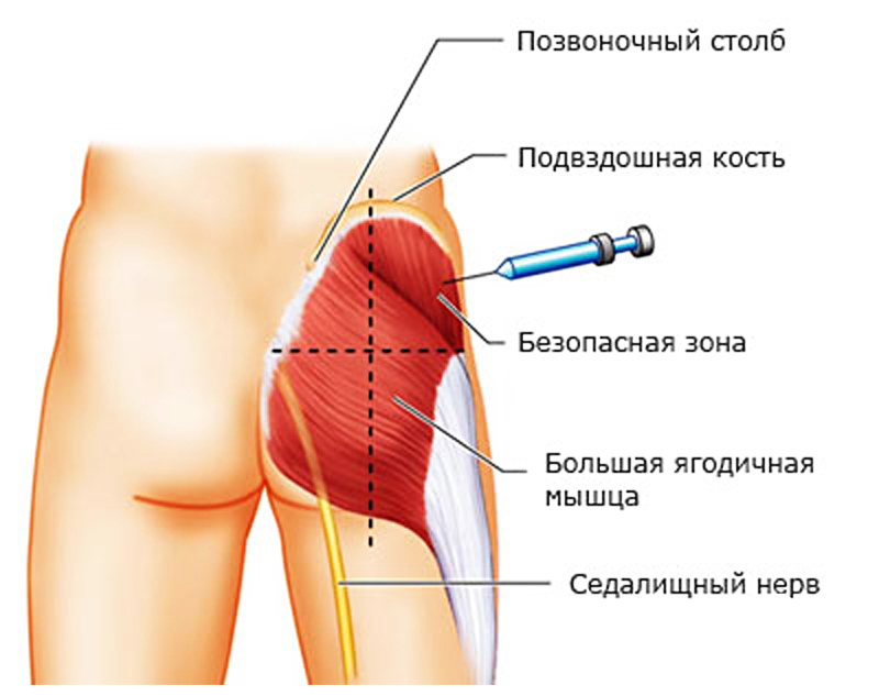 Схема внутримышечных инъекций