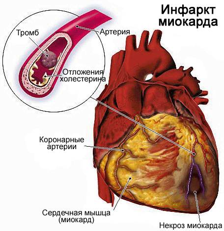 Инфаркт