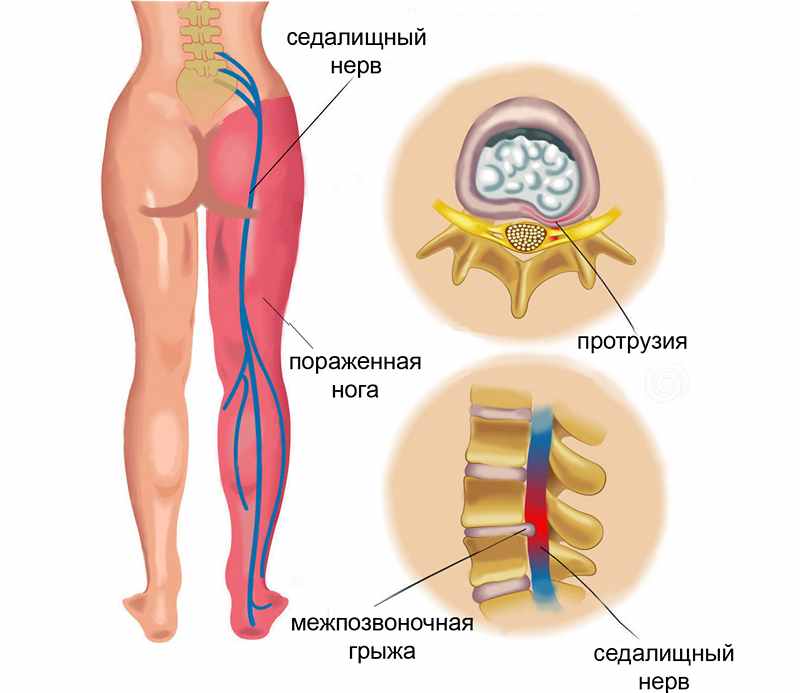 Ишиас на фоне грыжи позвоночника