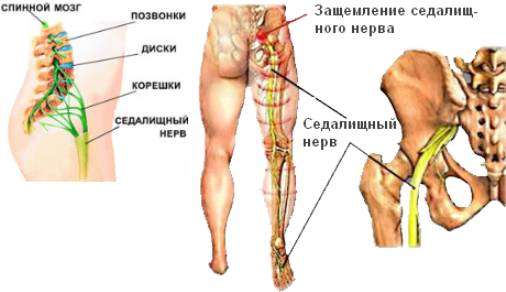 Ишиас — защемление седалищного нерва