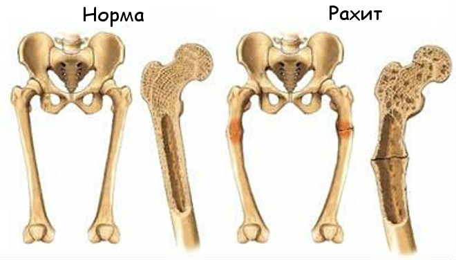 Искривление ног при рахите