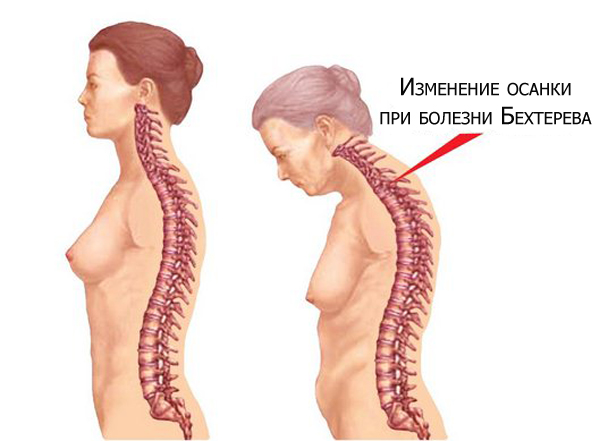 Искривление осанки при болезни Бехтерева