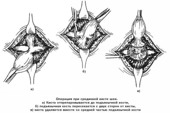 Иссечение кисты шеи