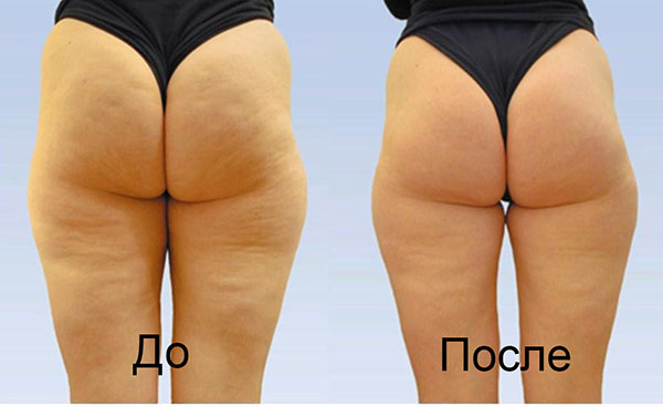 Уменьшение целлюлита