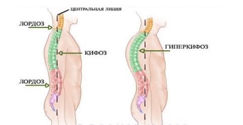 Кифоз и гиперкифоз