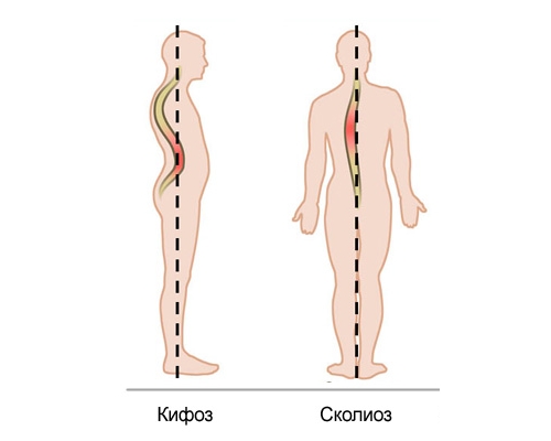 Кифоз и сколиоз
