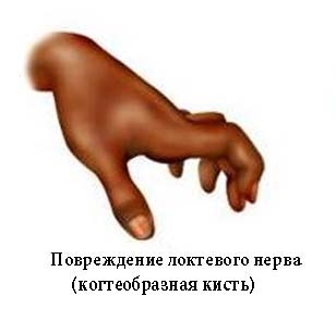 Кисть при повреждении локтевого нерва