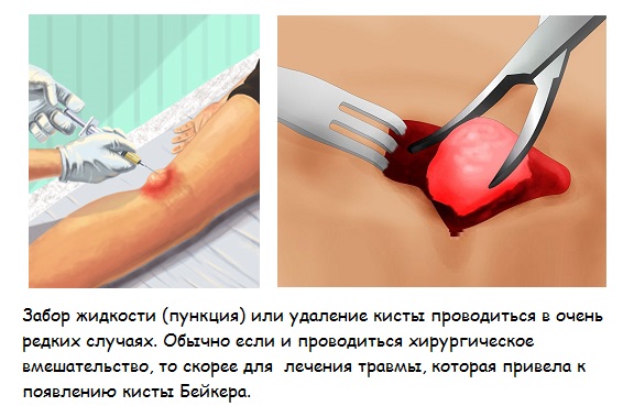 Пункция и удаление кисты Бейкера