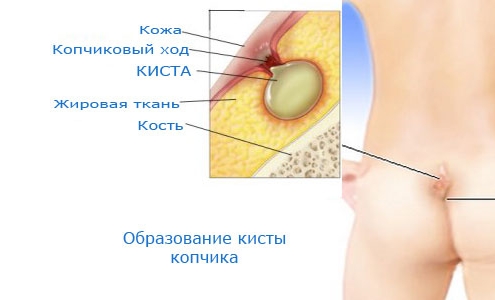 Киста копчика 
