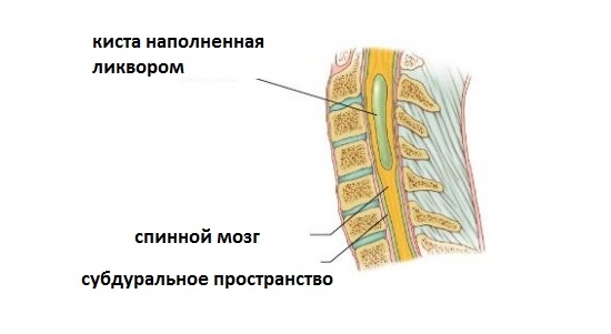 Возникновение кисты в спинном мозге